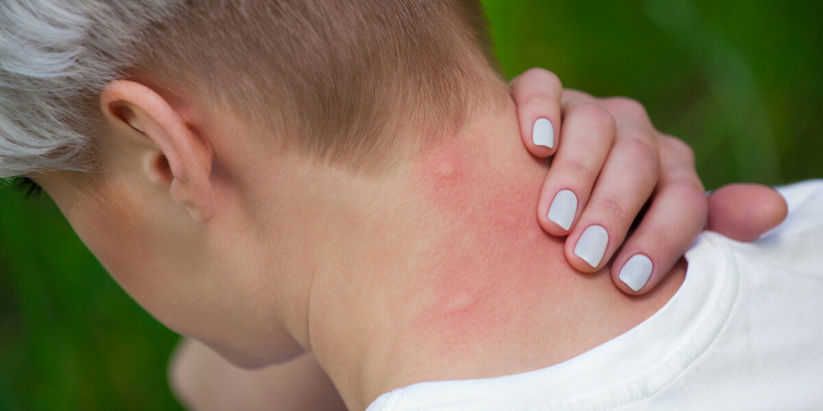 Bug Bite Guide • Health Blog • Community Care Physicians